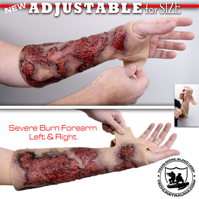 Severe Burn Forearm (Left)