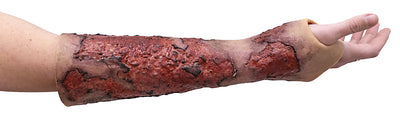 Severe Burn Forearm (Right)