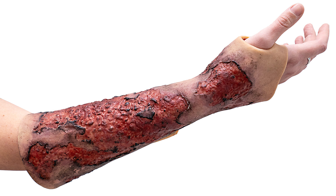 Severe Burn Forearm (Right)