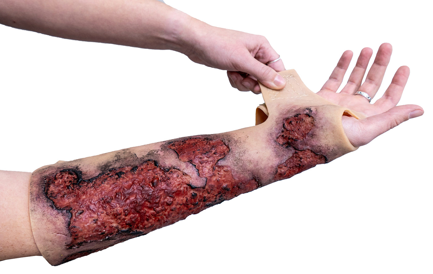 Severe Burn Forearm (Right)