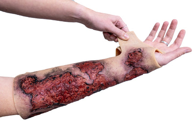 Severe Burn Forearm (Right)