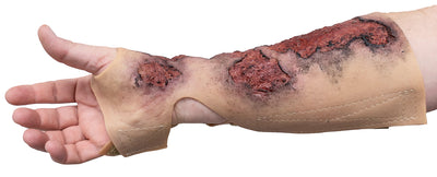 Severe Burn Forearm (Right)