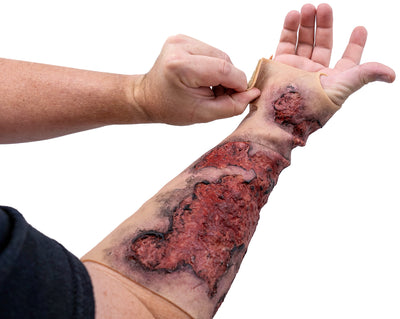 Severe Burn Forearm (Right)