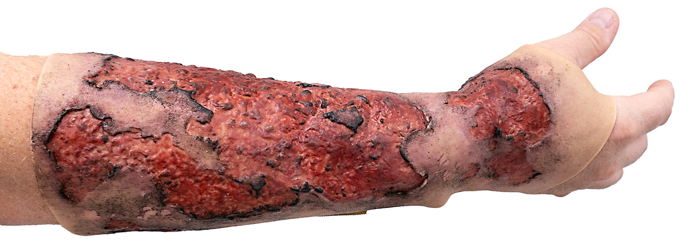 Severe Burn Forearm (Right)