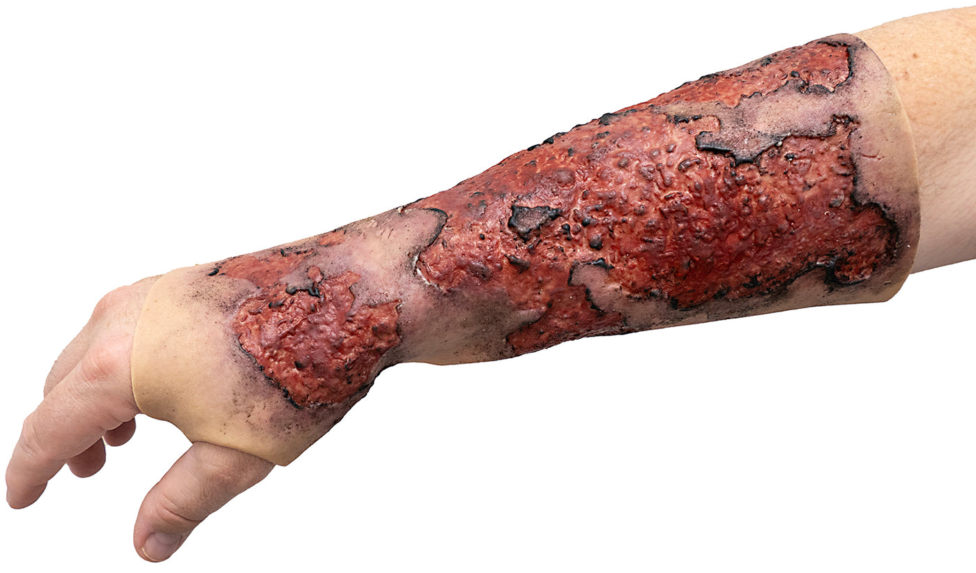 Severe Burn Forearm (Right)