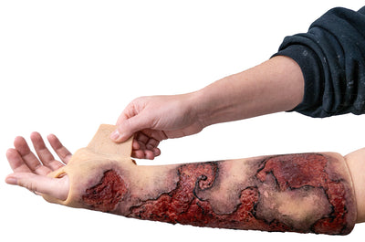 Severe Burn Forearm (Left)