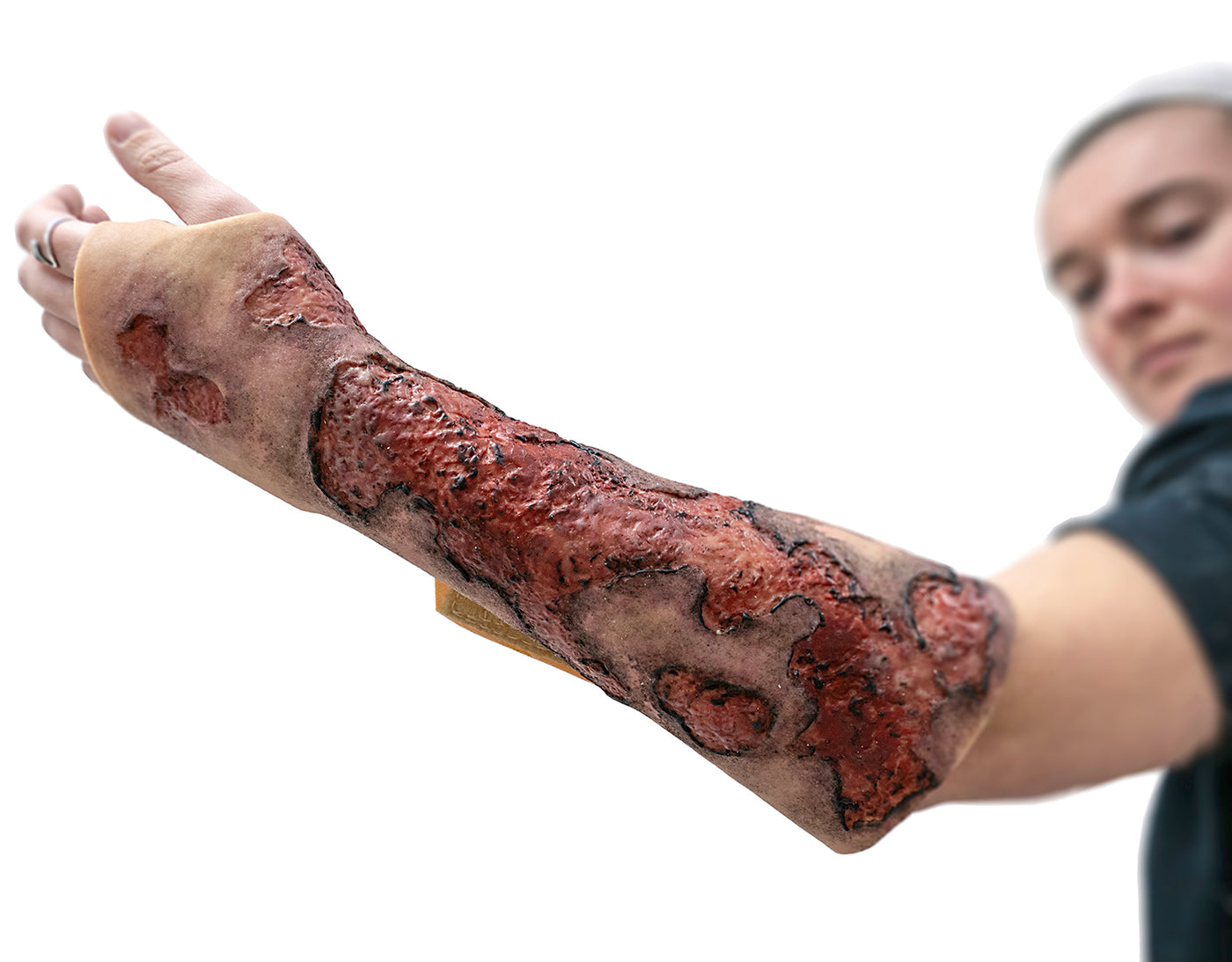 Severe Burn Forearm (Left)