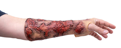 Severe Burn Forearm (Left)