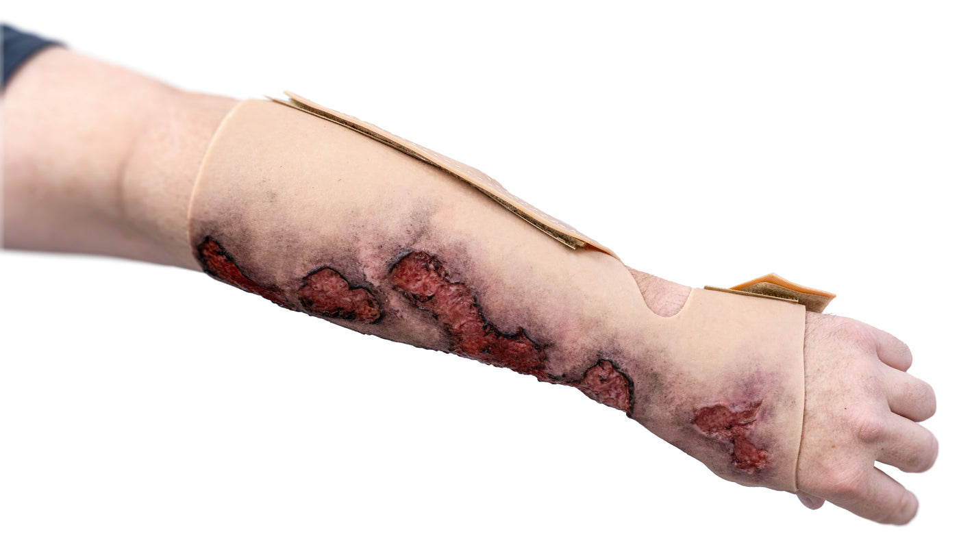 Severe Burn Forearm (Left)