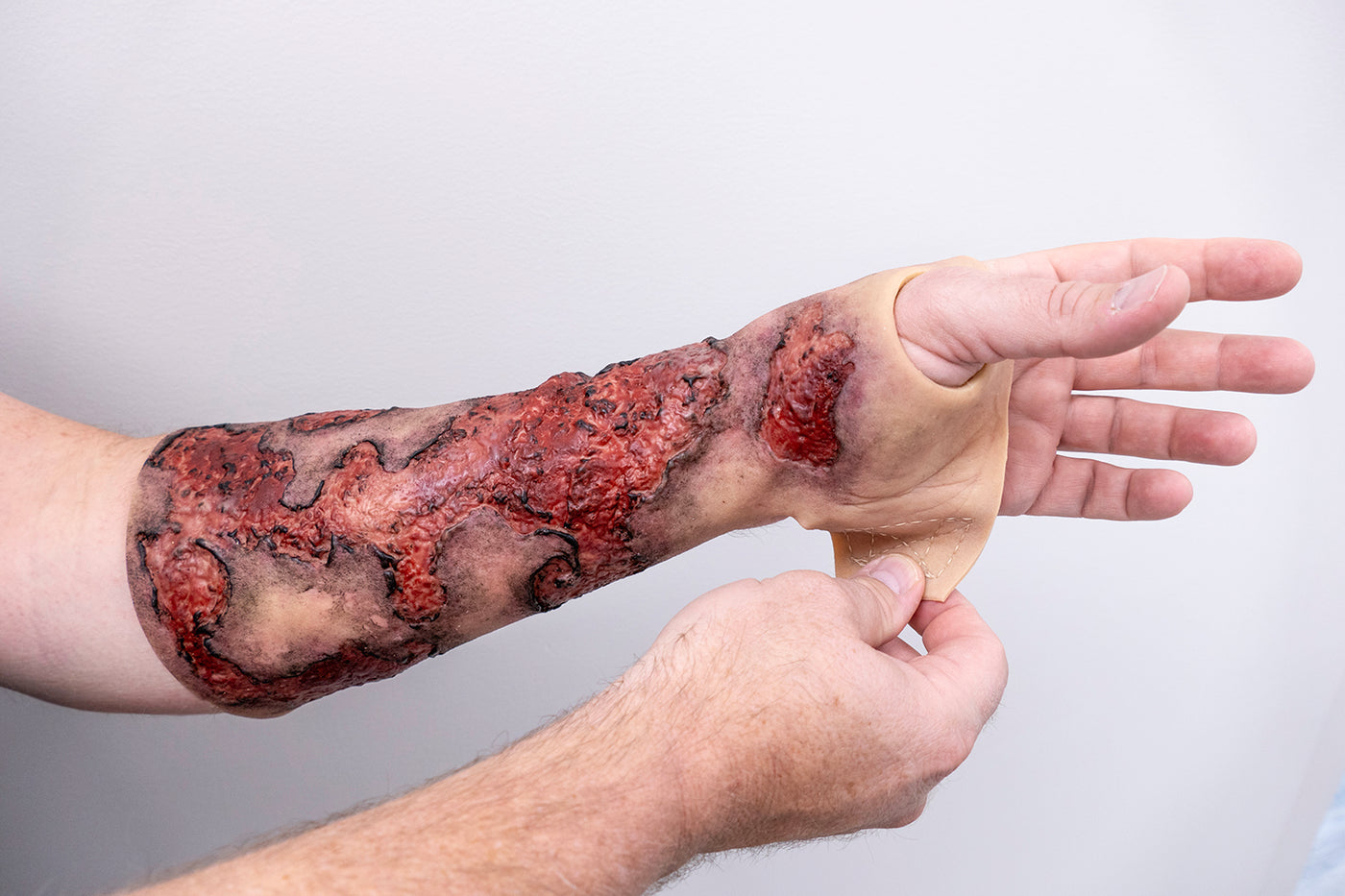 Severe Burn Forearm (Left)