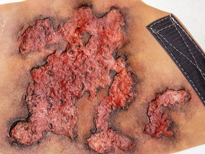 Severe Burn Forearm (Right)