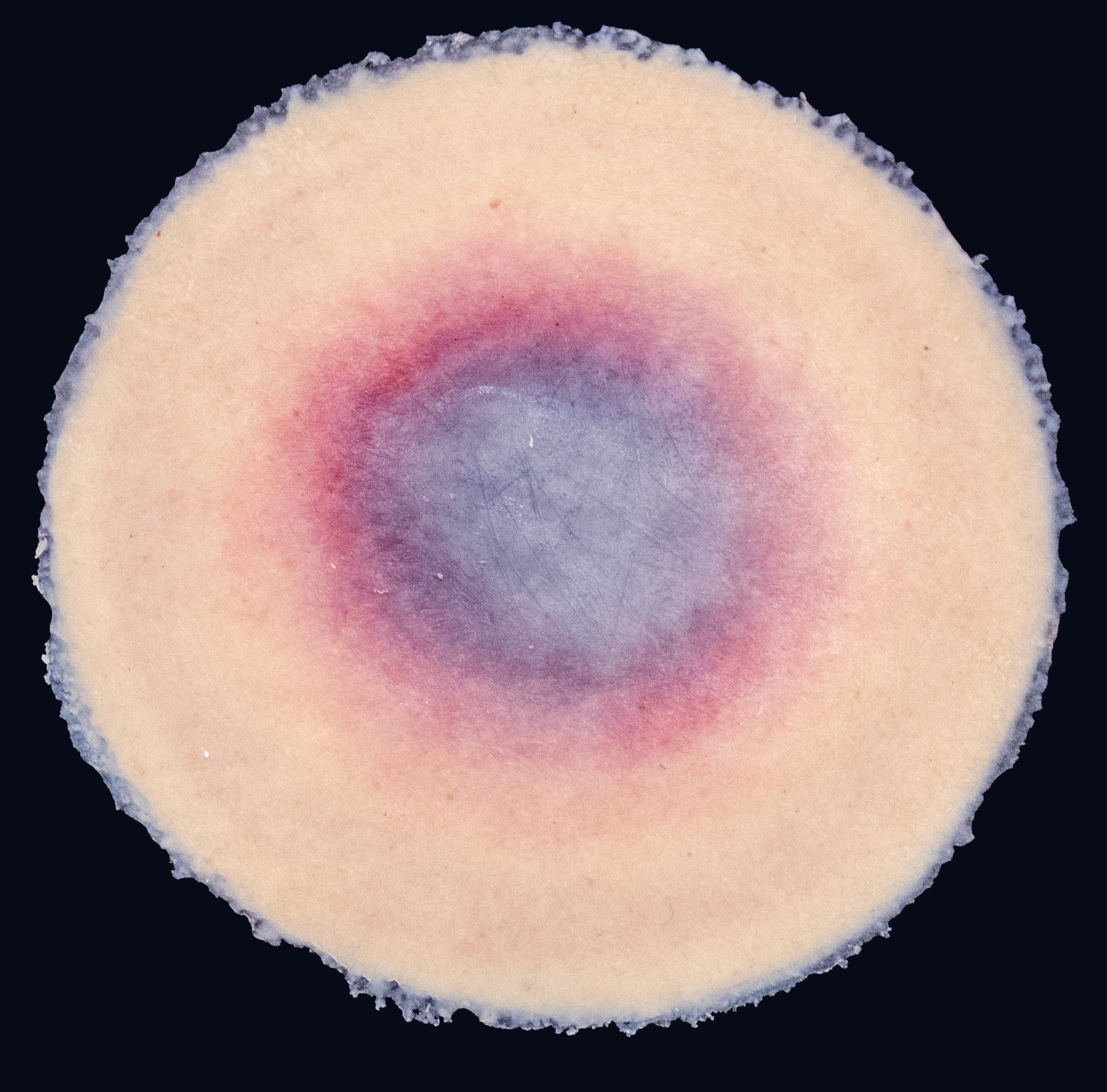 Deep Tissue Injury – Techline Trauma