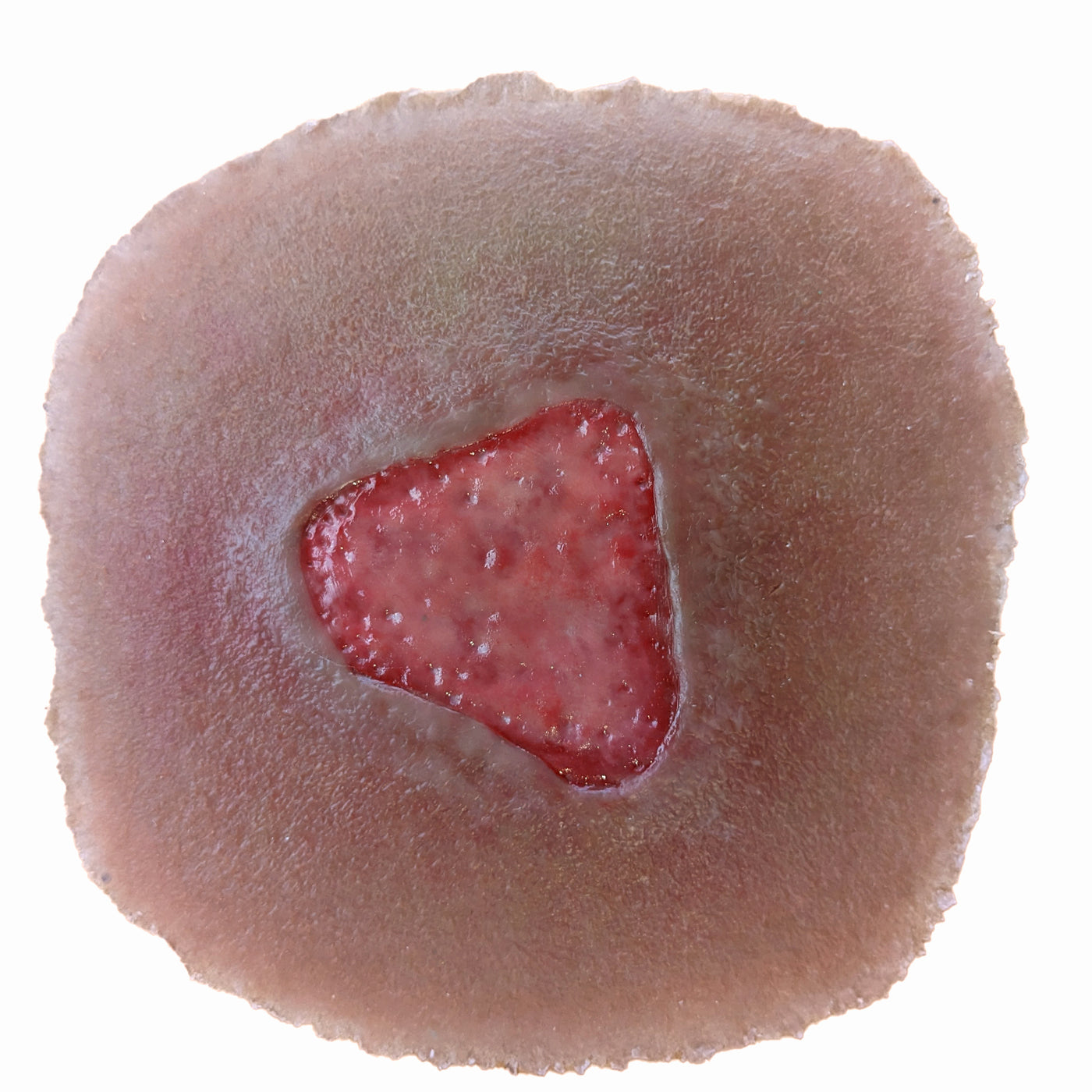 Stage 2 Pressure Injury