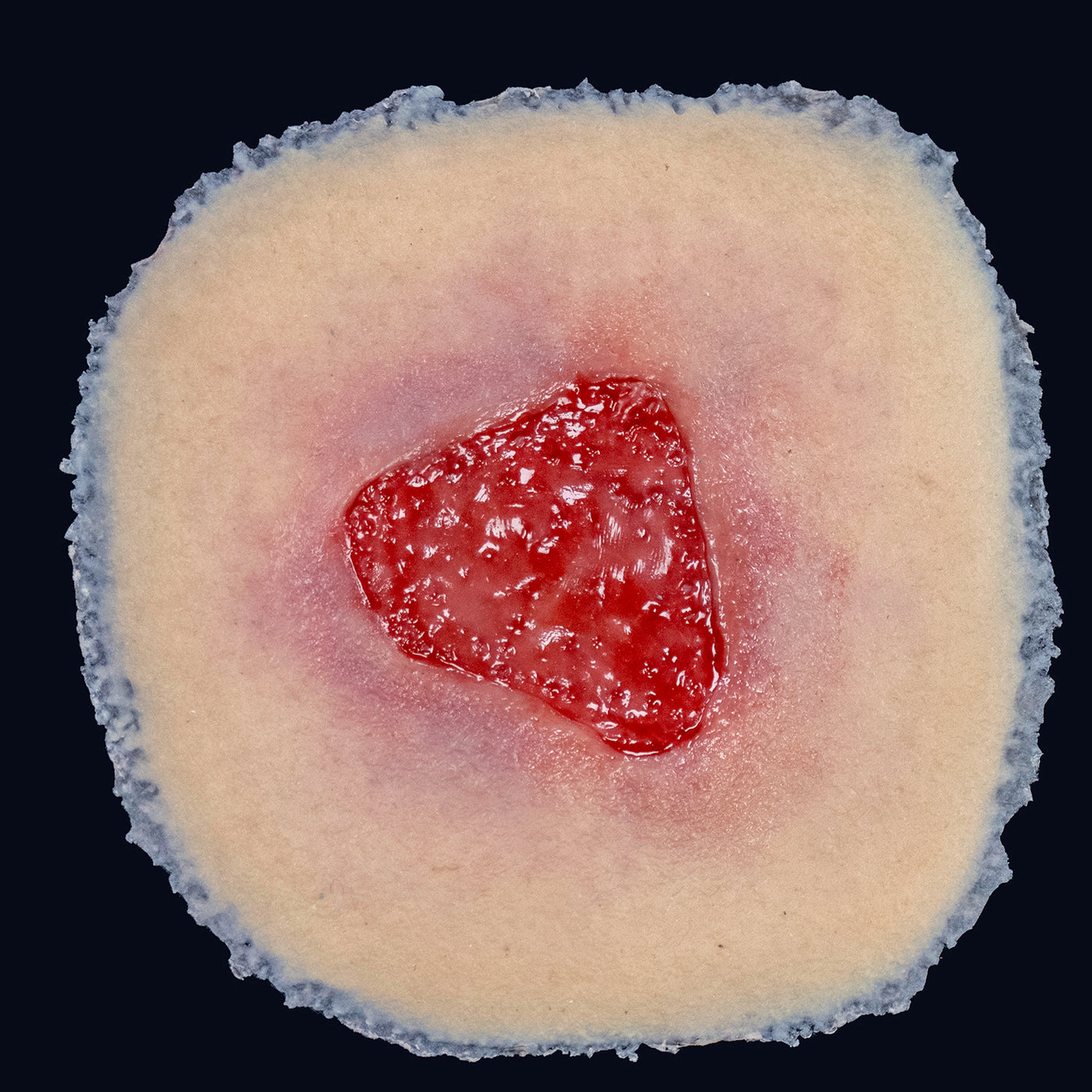 Stage 2 Pressure Injury