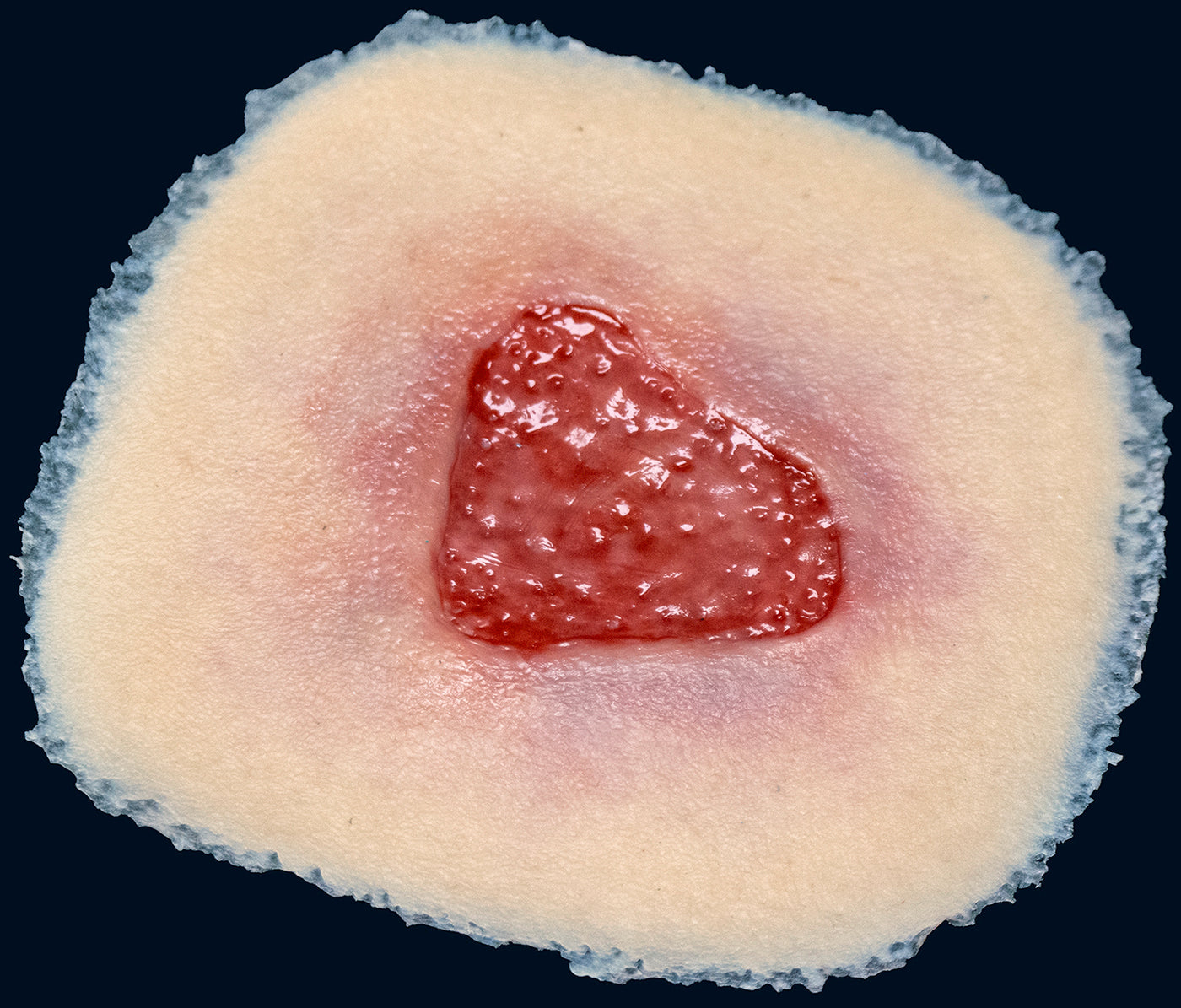 Stage 2 Pressure Injury