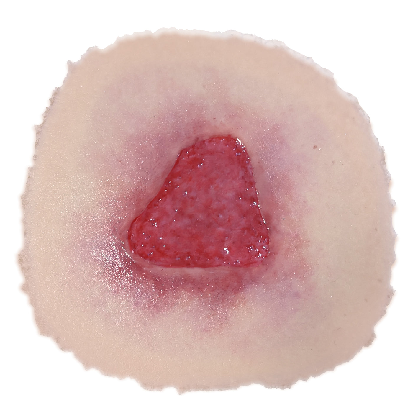 Stage 2 Pressure Injury