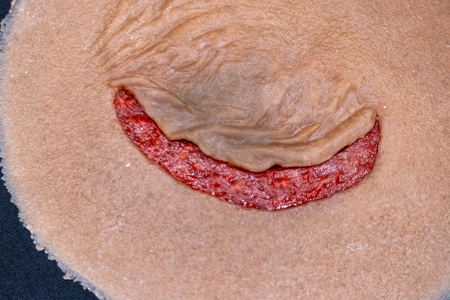 Skin Tear with Flap – Techline Trauma