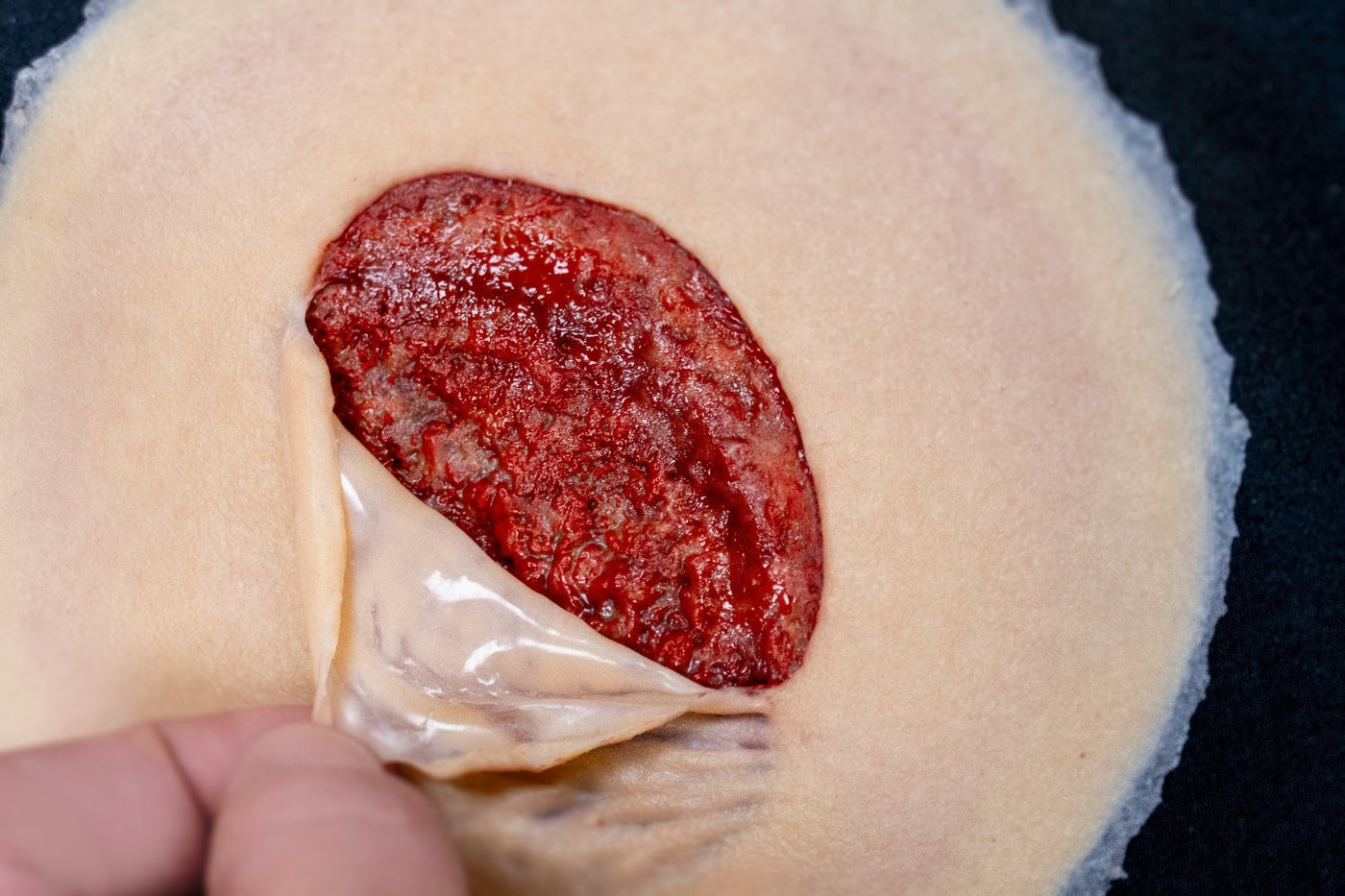 Skin Tear with Flap