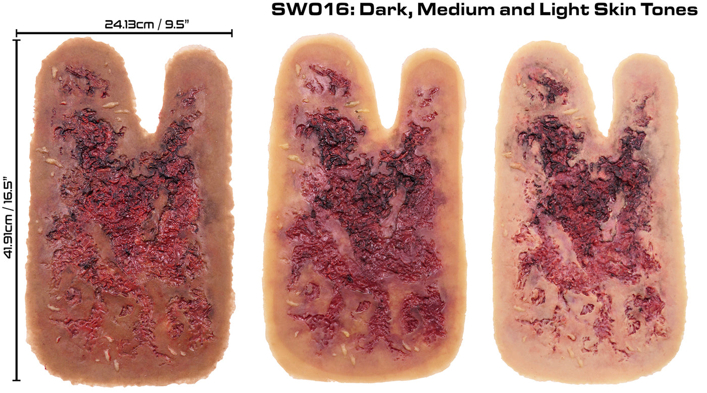 3rd Degree Thermal Arm Burn