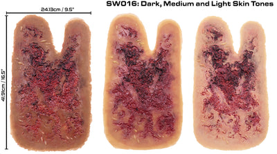 3rd Degree Thermal Arm Burn