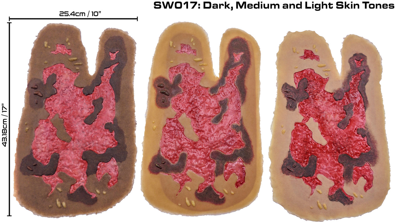 3rd Degree Thermal Arm Burn - Debrided