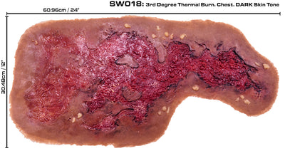 3rd Degree Thermal Chest Burn