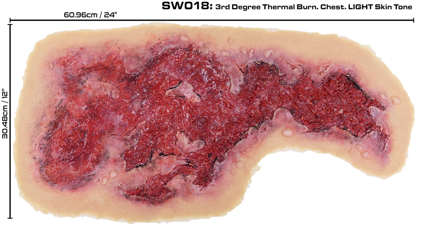 3rd Degree Thermal Chest Burn
