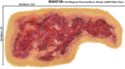 3rd Degree Thermal Chest Burn
