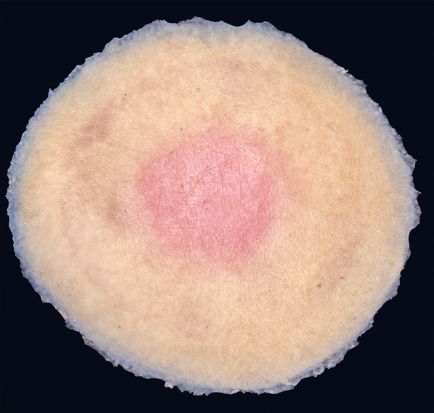 Stage 1 Pressure Injury Techline Trauma Stage 1 pressure injury techline trauma