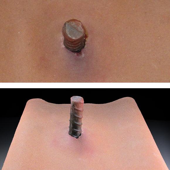 Impaled Object Example Impaled Object – Techline Trauma