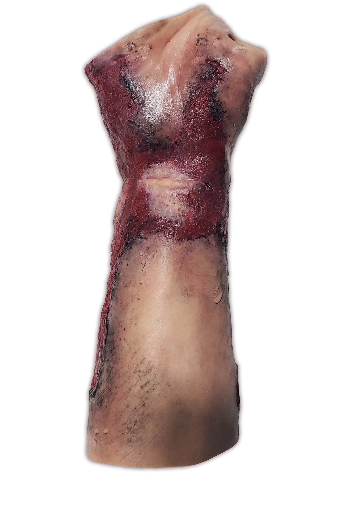 Severe Burn Forearm, Right Arm