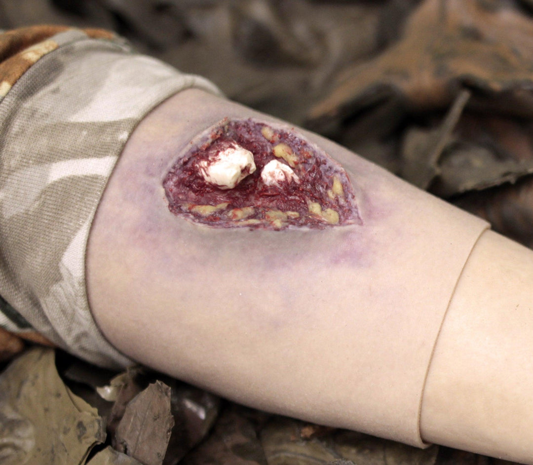 Compound Radial Break Compound Fracture Arm