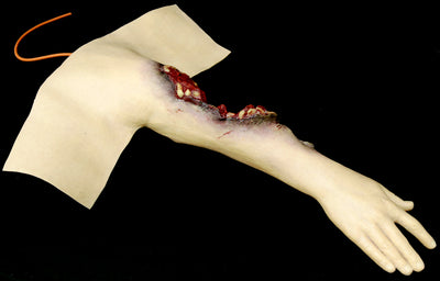 Partial Arm Amputation (Right)