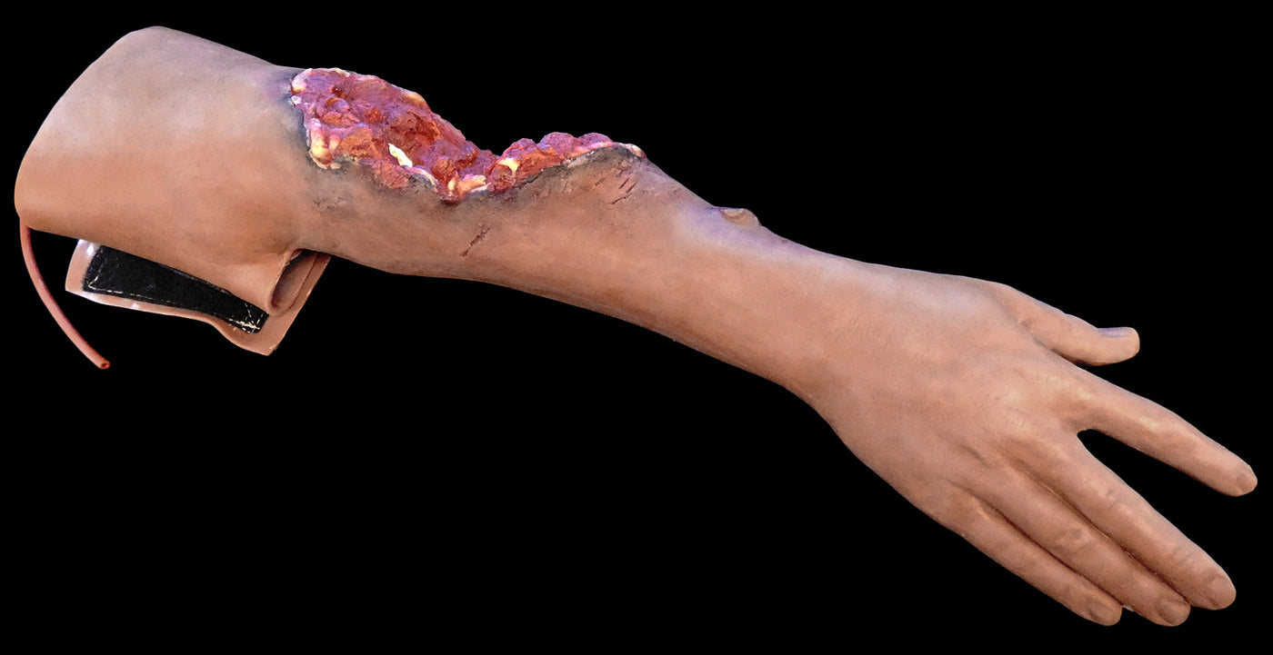 Partial Arm Amputation (Right)