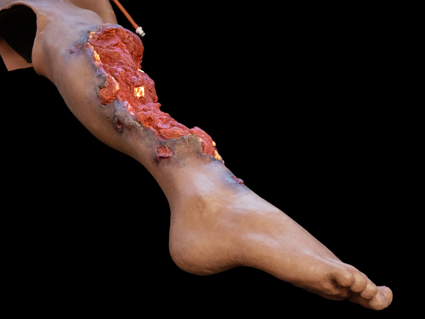Partial Leg Amputation (Right)