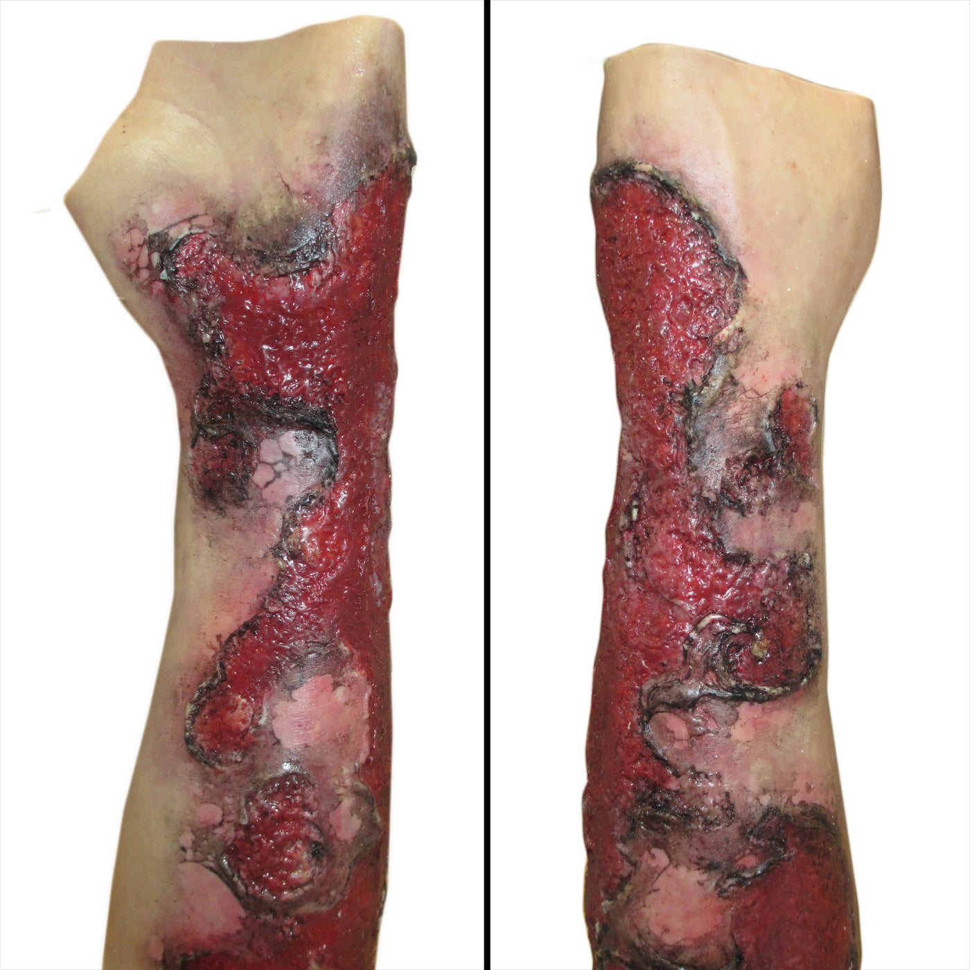 Severe Burn Forearm (Left)