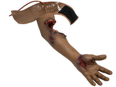 Partial Arm Amputation (Left)