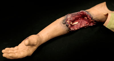 Partial Arm Amputation (Left)