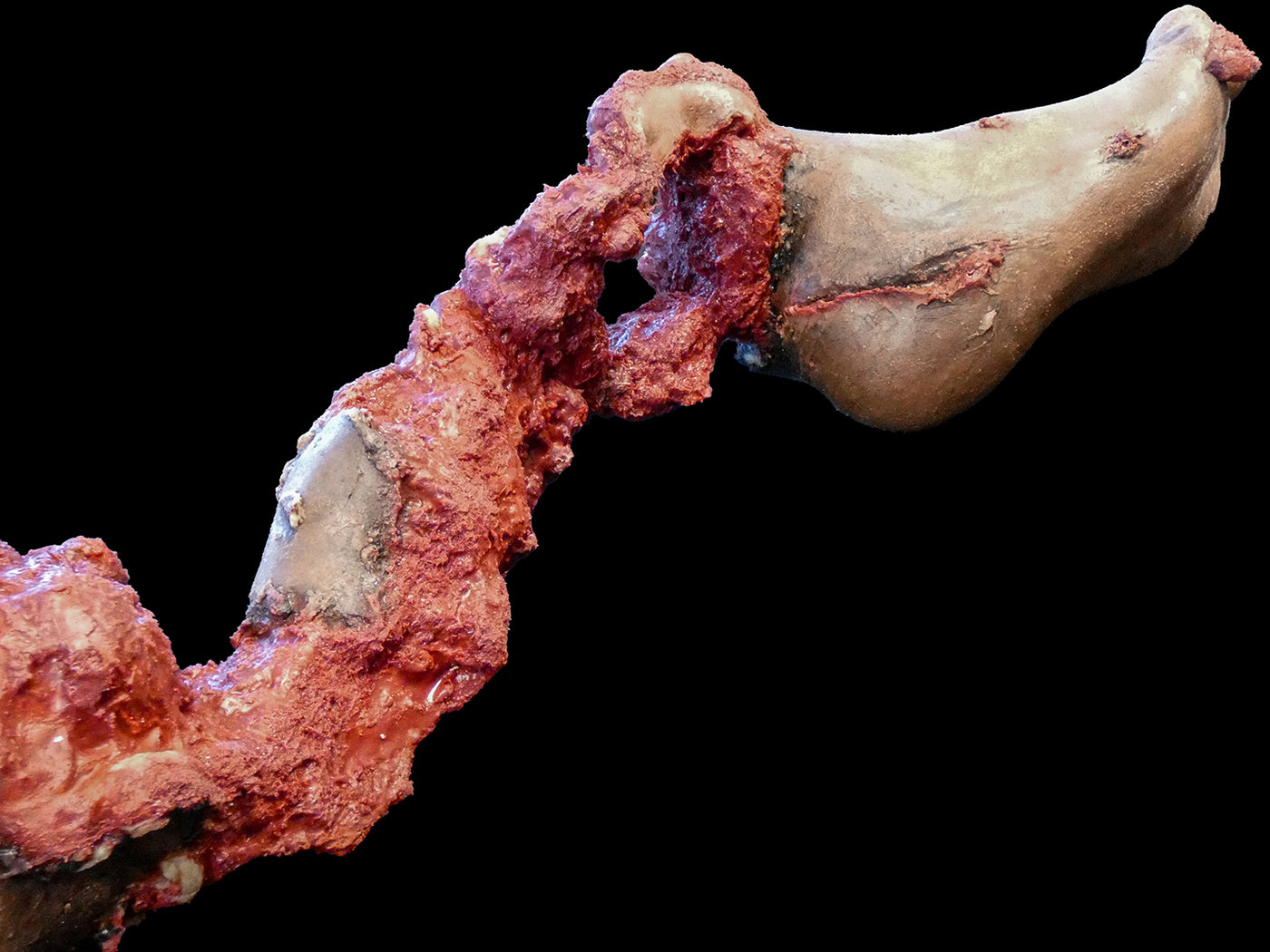 Partial Leg Amputation Hard Bone (Right)