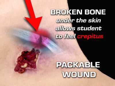 Broken Bone crepitus  Packable wound