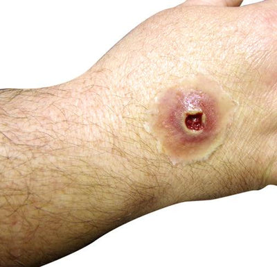 GS Entry Wound- Small