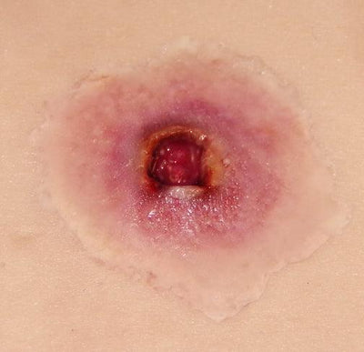 GS Entry Wound- Small