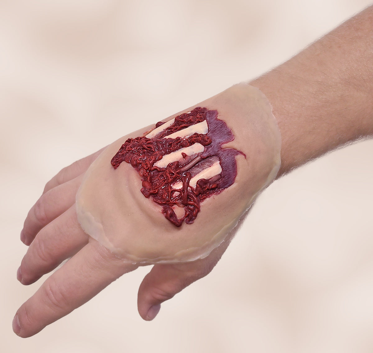 Degloved Hand Injury - Self Adhesive SW015