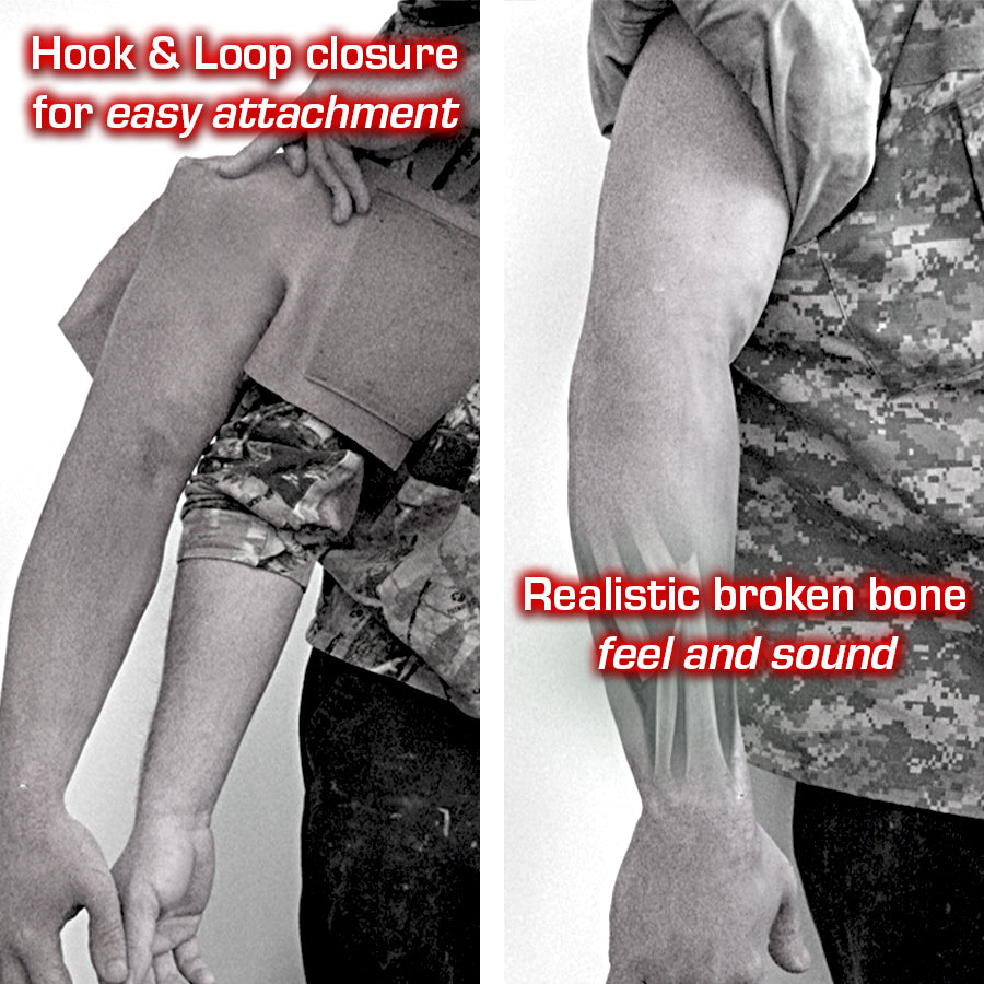 Closed Arm Fracture (Right Arm)